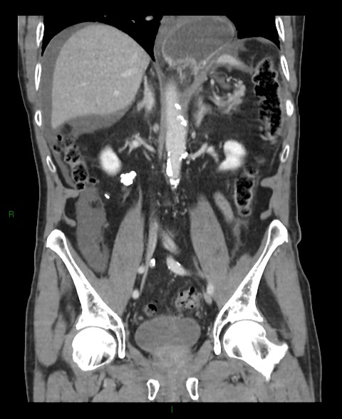 File:Closed loop small bowel obstruction with ischemia (Radiopaedia 84180-99456 B 30).jpg