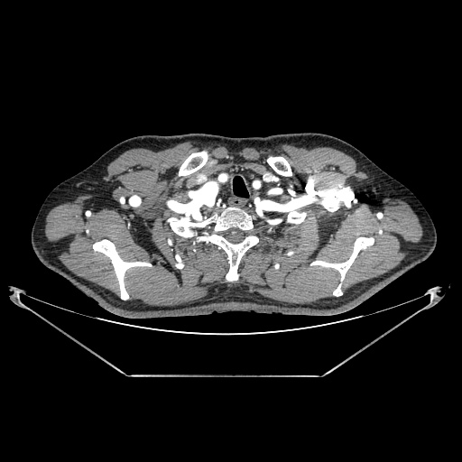 Coarctation of aorta (Radiopaedia 25384-25630 A 5).jpg