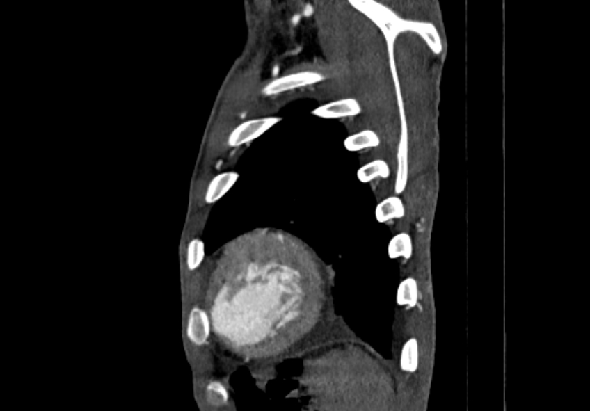 Coarctation of aorta with aortic valve stenosis (Radiopaedia 70463-80574 B 216).jpg