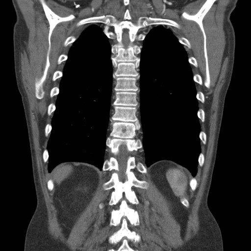File:Coarctation of the aorta (Radiopaedia 17427-17116 A 22).jpg