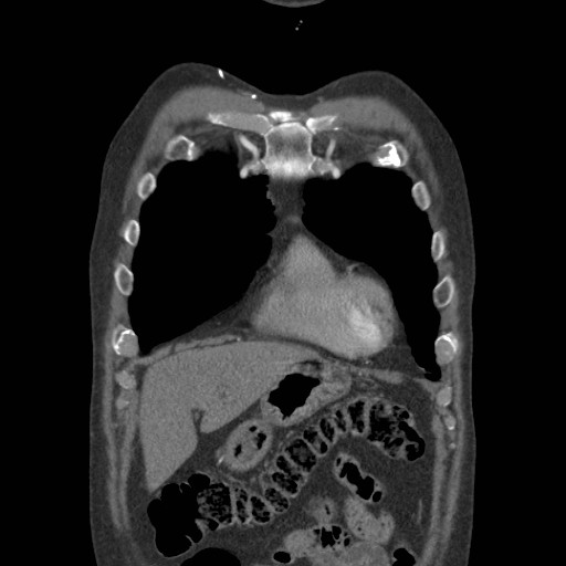 File:Coarctation of the aorta (Radiopaedia 17427-17116 A 71).jpg