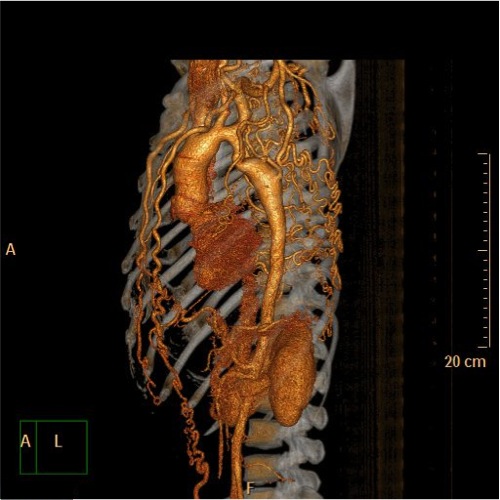 File:Coarctation of the aorta (Radiopaedia 40877-43571 A 3).jpg