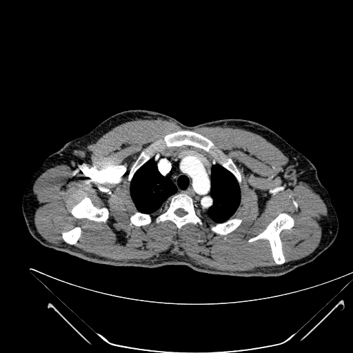 File:Coarctation of the aorta (Radiopaedia 49784-55050 B 16).jpg