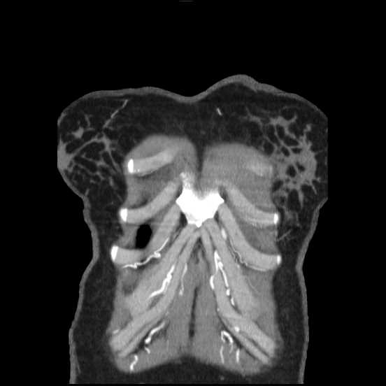 Coarctation of the aorta (Radiopaedia 67609-77010 B 61).jpg