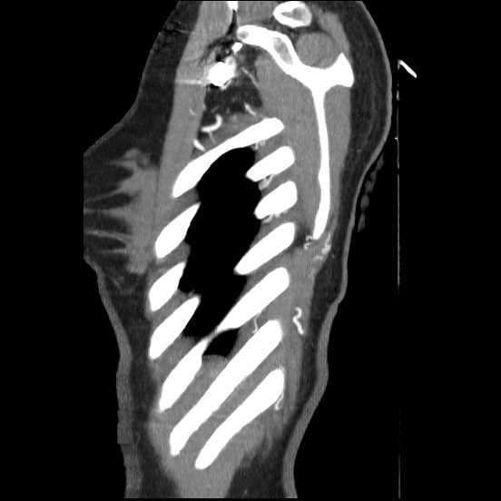 Coarctation of the aorta (Radiopaedia 67609-77010 C 6).jpg