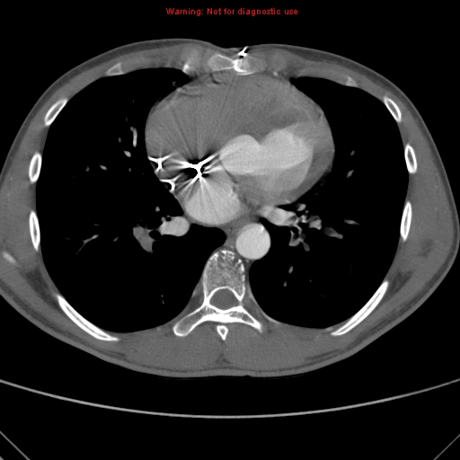 File:Coarctation of the aorta (Radiopaedia 9434-10118 A 115).jpg