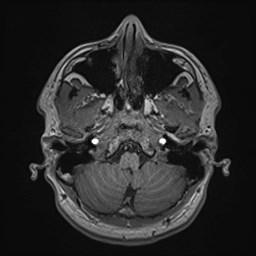 File:Cochlear incomplete partition type III associated with hypothalamic hamartoma (Radiopaedia 88756-105498 Axial T1 46).jpg