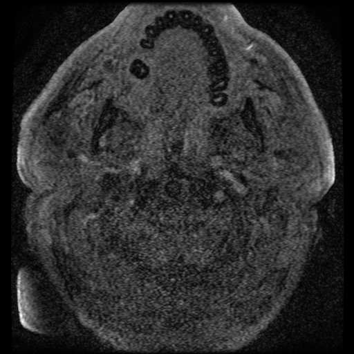 File:Colloid cyst with anterior communicating artery aneurysm (Radiopaedia 33901-35091 Axial MRA 1).jpg