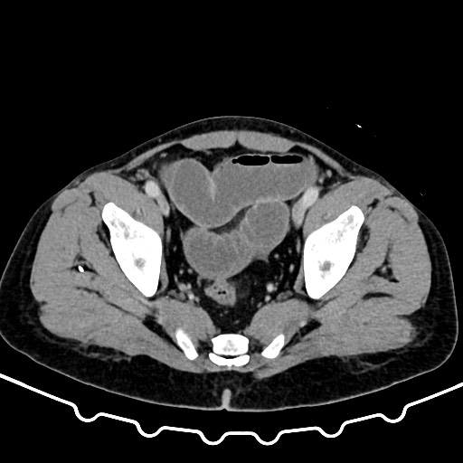 Colocolic intussusception due to large lipoma (Radiopaedia 68773-78482 A 167).jpg