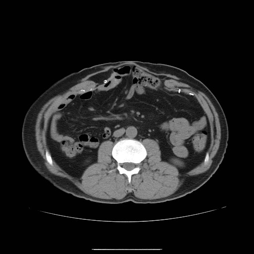 File:Colocutaneous fistula in Crohn's disease (Radiopaedia 29586-30093 Axial non-contrast 4).jpg