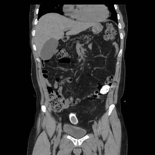File:Colocutaneous fistula in Crohn's disease (Radiopaedia 29586-30093 E 11).jpg