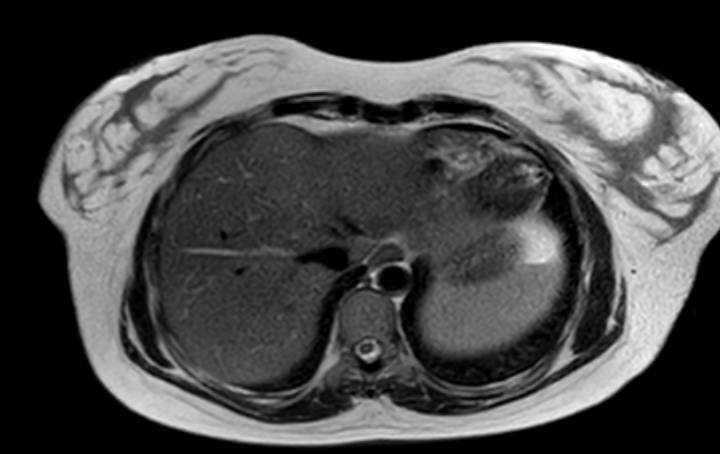 Colon adenocarcinoma with Krukenberg tumors, advanced pregnancy (Radiopaedia 67279-76645 Axial T2 76).jpg