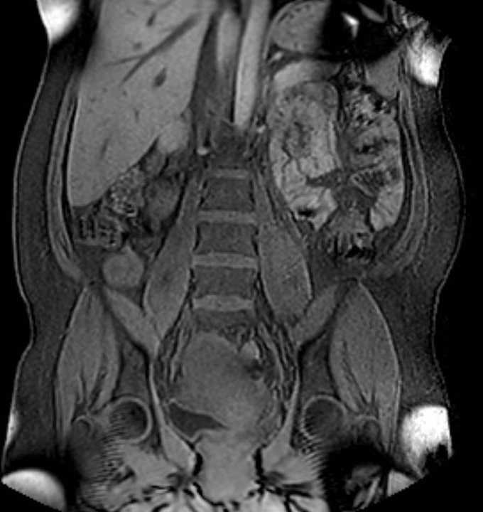 Colon adenocarcinoma with Krukenberg tumors, advanced pregnancy (Radiopaedia 67279-76645 E 54).jpg