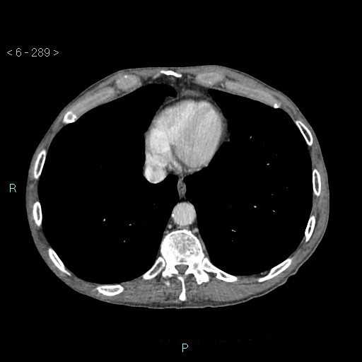 Colonic cancer (ultrasound and TC imaging) (Radiopaedia 50346-55713 B 289).jpg