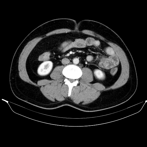 File:Colonic lipoma with colo-colic intussusception (Radiopaedia 58944-66200 Axial 15).jpg