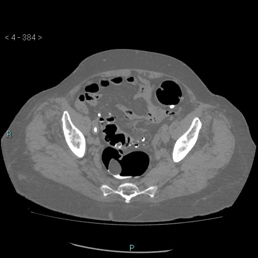 Colonic lipomas (Radiopaedia 49137-54244 Axial bone window 172).jpg