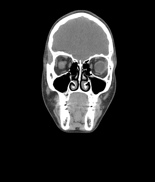 File:Nasal pyogenic granuloma (lobular capillary hemangioma) (Radiopaedia 85536-101244 Coronal non-contrast 74).jpg