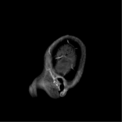 File:Nasopharyngeal carcinoma with cerebral abscess (Radiopaedia 43018-46274 J 9).png
