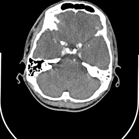 Nasopharyngeal carcinoma with skull base invasion (Radiopaedia 53415-59705 A 3).jpg