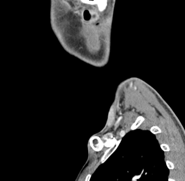 Nasopharyngeal carcinoma with skull base invasion (Radiopaedia 53415-59705 C 4).jpg