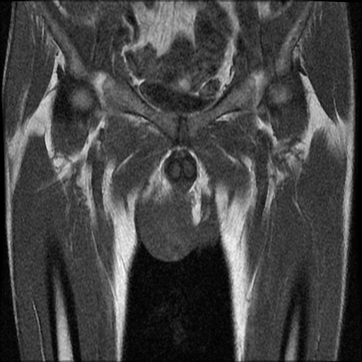 File:Necrotizing epididymo-orchitis with intra-testicular abscess (Radiopaedia 29397-29860 Coronal T1 10).jpg