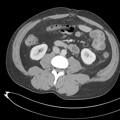 File:Necrotizing pancreatitis with acute necrotic collections (Radiopaedia 38829-41012 B 44).png