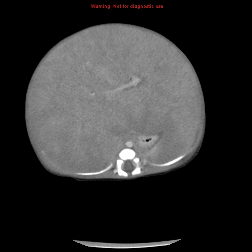 File:Neonatal neuroblastoma (Radiopaedia 9564-10223 A 21).jpg