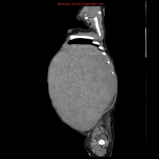 File:Neonatal neuroblastoma (Radiopaedia 9564-10223 C 28).jpg