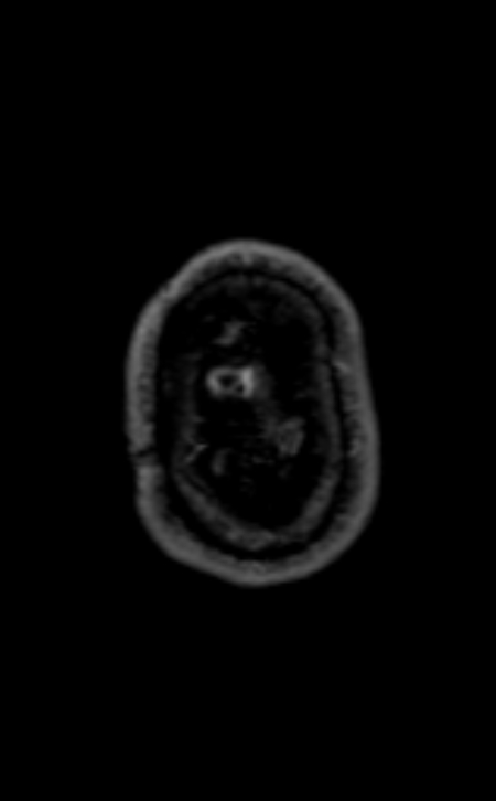 Neuro-Behçet disease (Radiopaedia 90112-107294 Axial T1 C+ 53).jpg