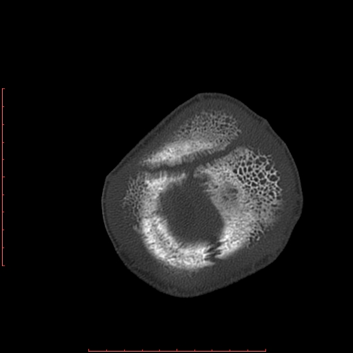 File:Neuroblastoma skull metastasis (Radiopaedia 56053-62683 Axial bone window 25).jpg