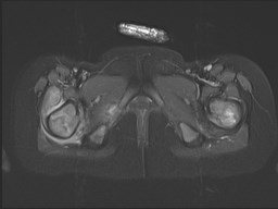File:Neuroblastoma with bone metastases (Radiopaedia 67080-76414 Axial STIR 43).jpg