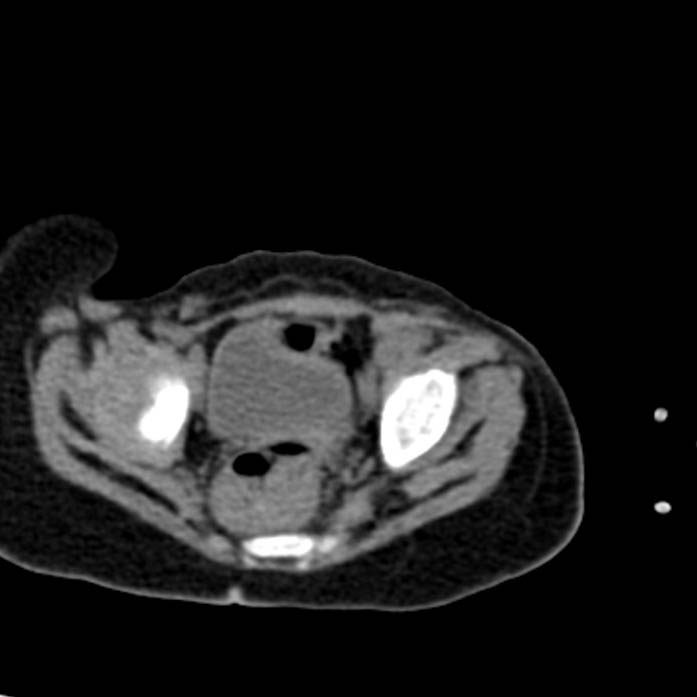 Neuroblastoma with skull metastases (Radiopaedia 30326-30960 Axial non-contrast 55).jpg