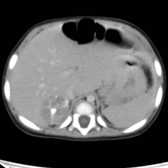 Neuroblastoma with skull metastases (Radiopaedia 30326-30960 C 12).jpg