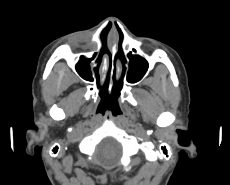 Neurofibromatosis type 1- orbital manifestations (Radiopaedia 49391-54511 Axial non-contrast 31).jpg