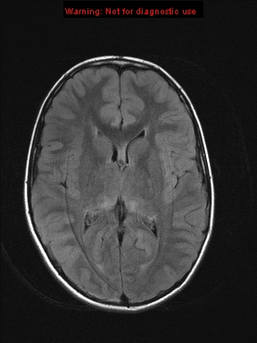 File:Neurofibromatosis type 1 with optic nerve glioma (Radiopaedia 16288-15965 Axial FLAIR 12).jpg
