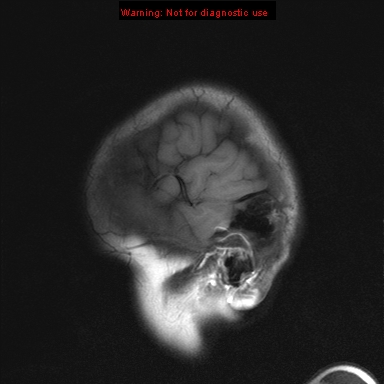 File:Neurofibromatosis type 1 with optic nerve glioma (Radiopaedia 16288-15965 Sagittal T1 2).jpg