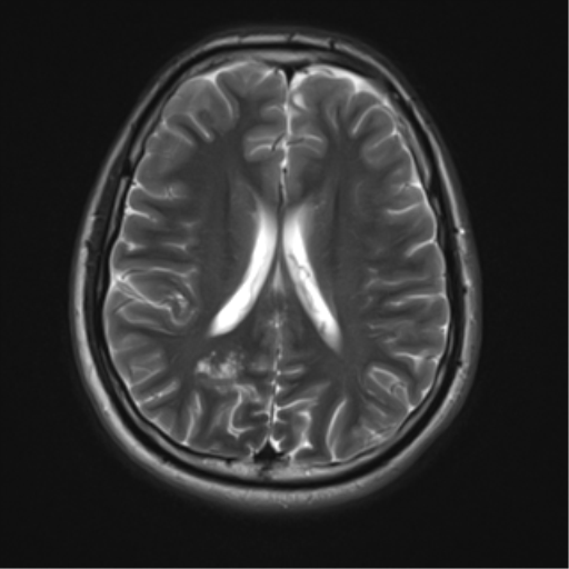 File:Neurofibromatosis type 2 (Radiopaedia 44936-48838 Axial T2 15).png