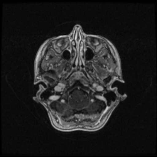 Neurofibromatosis type 2 (Radiopaedia 45229-49244 Axial T1 C+ 30).png