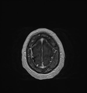Neurofibromatosis type 2 (Radiopaedia 79097-92049 Axial T1 C+ 176).jpg