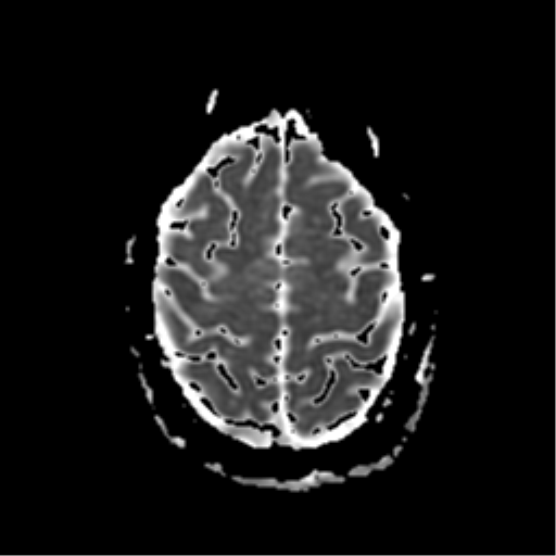File:Neurofibromatosis type 2 - bilateral acoustic neuromata (Radiopaedia 40060-42566 Axial ADC 18).png