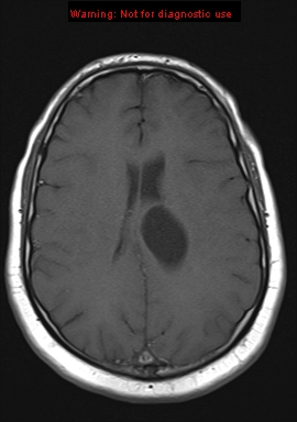 File:Neuroglial cyst (Radiopaedia 10713-11184 Axial T1 9).jpg