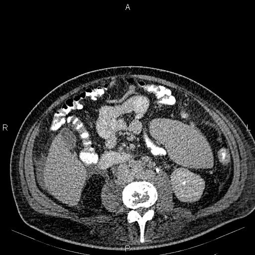 Non Hodgkin lymphoma in a patient with ankylosing spondylitis (Radiopaedia 84323-99621 Axial C+ delayed 39).jpg