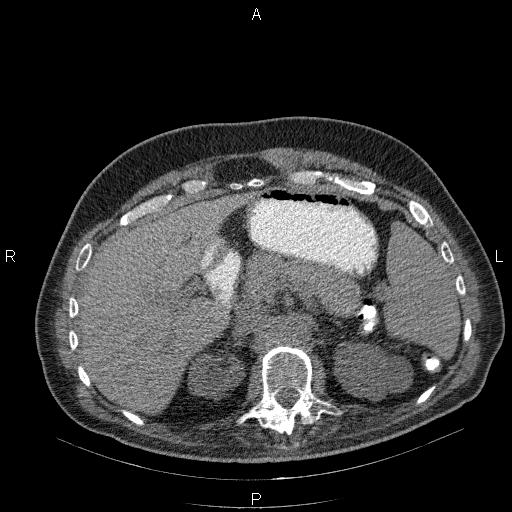 File:Non Hodgkin lymphoma in a patient with ankylosing spondylitis (Radiopaedia 84323-99624 Axial non-contrast 35).jpg