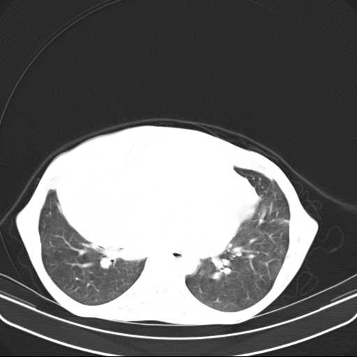 File:Non hodgkin lymphoma of the mediastinum (Radiopaedia 20814-20729 Axial lung window 34).jpg