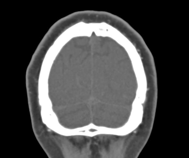 File:Normal CTA head (Radiopaedia 40801-43464 B 85).png