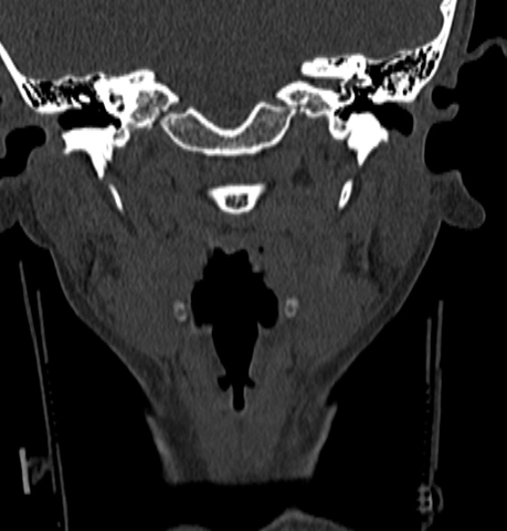 File:Normal CT cervical spine - 12-year-old (Radiopaedia 55352-61775 Coronal bone window 23).jpg