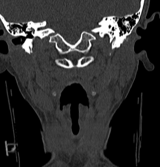 File:Normal CT cervical spine - 12-year-old (Radiopaedia 55352-61775 Coronal bone window 33).jpg