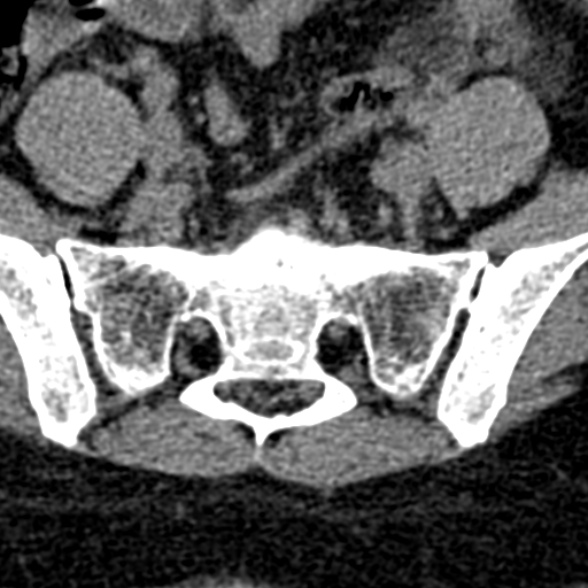 Normal CT lumbar spine (Radiopaedia 53981-60118 Axial non-contrast 96).jpg