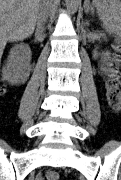 Normal CT lumbar spine (Radiopaedia 53981-60118 F 35).jpg