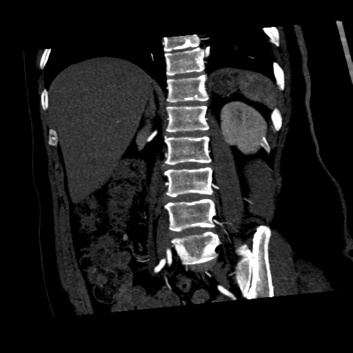 File:Normal CT renal artery angiogram (Radiopaedia 38727-40889 C 16).png